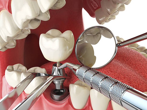 Best Knocked-Out Tooth (Avulsed Tooth) Treatment in West Glens Falls, NY